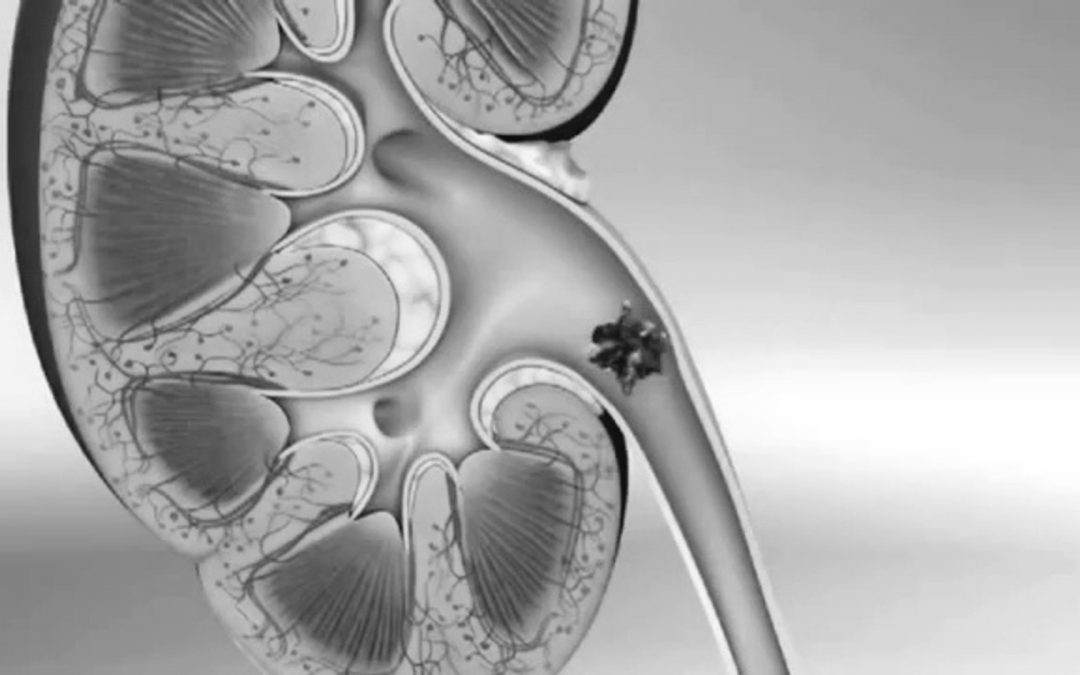 Mayo Clinic Study Reveals Dietary Trick To Prevent Kidney Stones